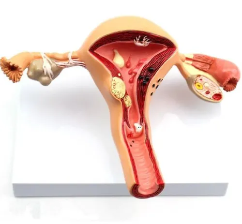 Image of Uterus and Ovary Anatomy Model With Common Pathologies (Premium Quality)